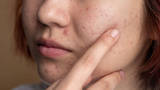 pessoas-com-acne-enfrentam-preconceitos-que-prejudicam-vida-social-e-profissional,-mostra-estudo